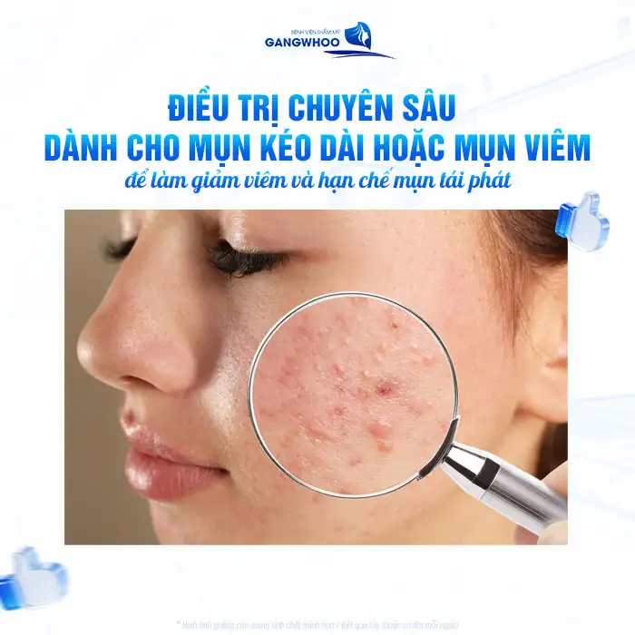Tìm hiểu về mụn trán và cách điều trị an toàn, hiệu quả