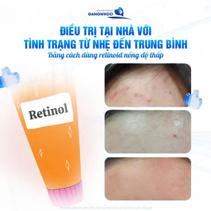 Tìm hiểu về mụn trán và cách điều trị an toàn, hiệu quả