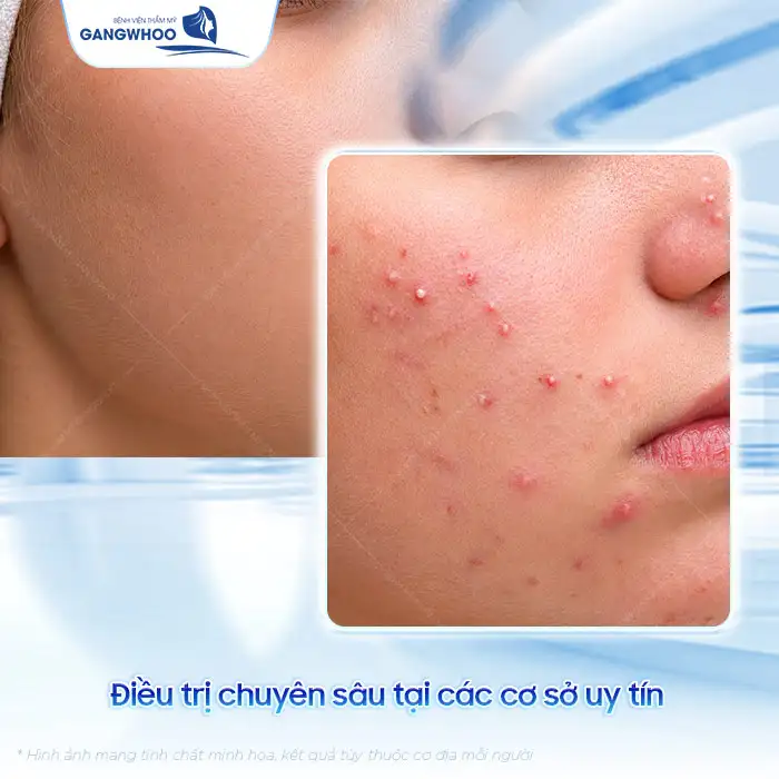 Mụn trứng cá đỏ và cách điều trị đúng cách tránh biến chứng