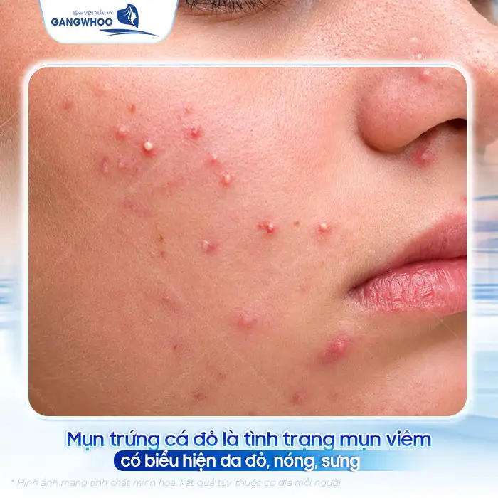 Mụn trứng cá đỏ và cách điều trị đúng cách tránh biến chứng