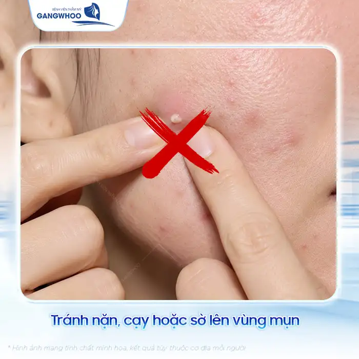 Mụn trứng cá đỏ và cách điều trị đúng cách tránh biến chứng