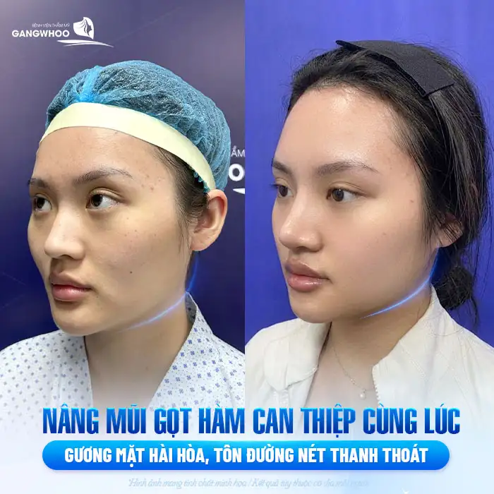 Nâng mũi gọt hàm cùng 1 lúc được không? Có ảnh hưởng sức khỏe
