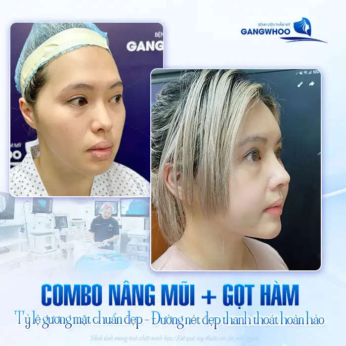 Nâng mũi gọt hàm cùng 1 lúc được không? Có ảnh hưởng sức khỏe