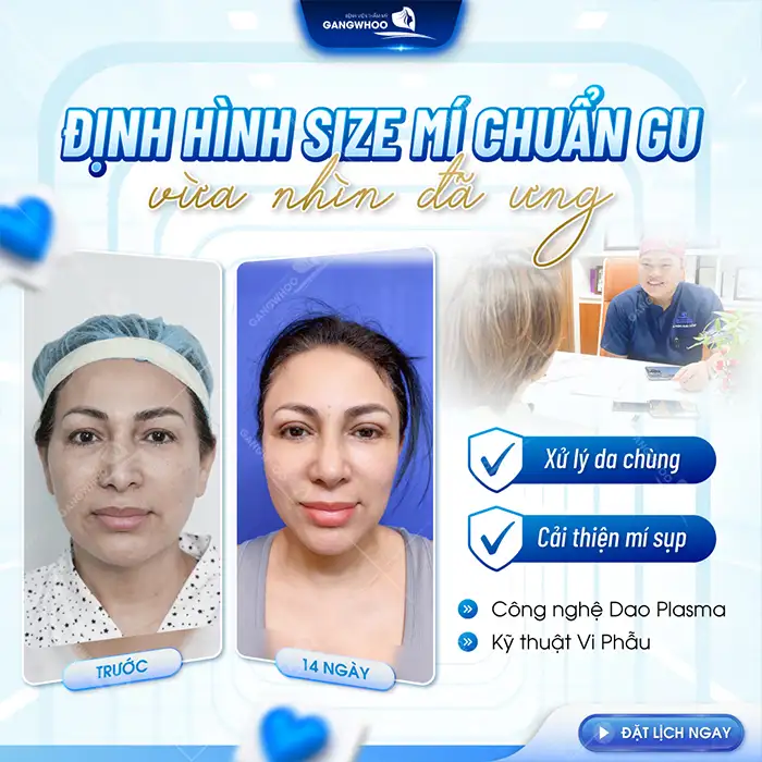 Nên nâng cung mày hay cắt mí để có đôi mắt to tròn, tự nhiên