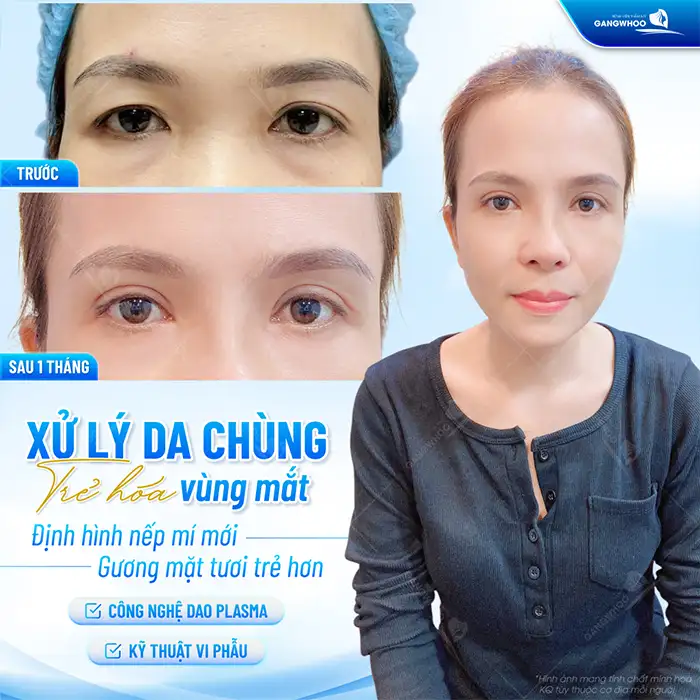 Nên nâng cung mày hay cắt mí để có đôi mắt to tròn, tự nhiên