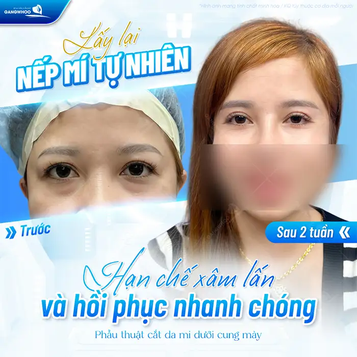 Nên nâng cung mày hay cắt mí để có đôi mắt to tròn, tự nhiên