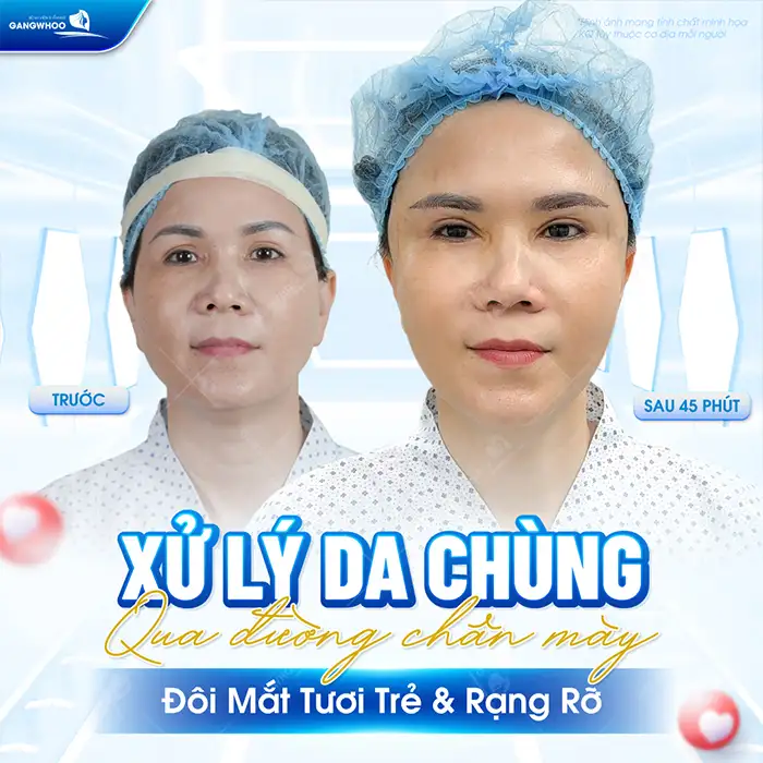 Nên nâng cung mày hay cắt mí để có đôi mắt to tròn, tự nhiên
