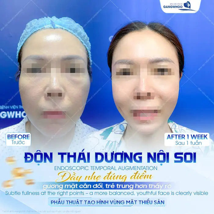 Nên hạ gò má hay độn thái dương? Phương pháp nào tối ưu hơn