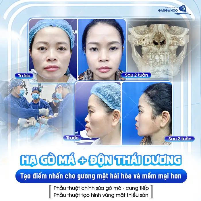 Nên hạ gò má hay độn thái dương? Phương pháp nào tối ưu hơn