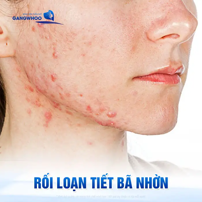 Nguyên nhân gây mụn và cách điều trị mụn hiệu quả, an toàn