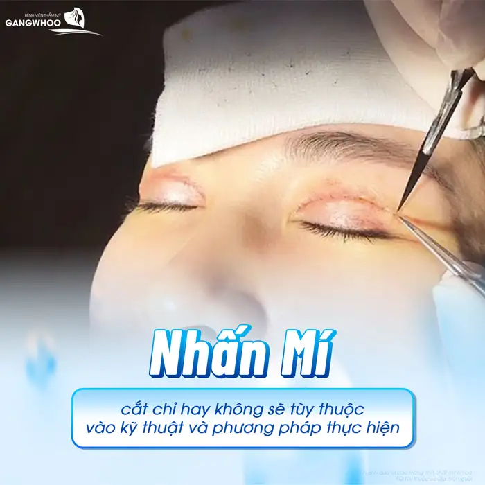 Nhấn mí có cần cắt chỉ không? Khi nào thì cần phải tháo chỉ?