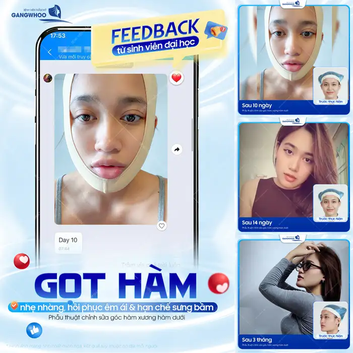 Những điều cần biết khi phẫu thuật gọt hàm để đảm bảo an toàn, hiệu quả