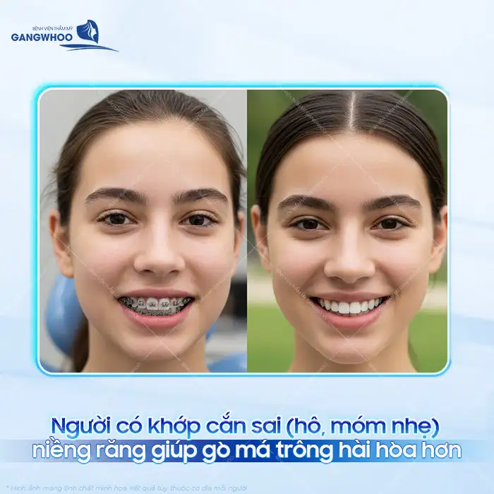 Niềng răng có hạ gò má không? Có tác động thay đổi gò má không?