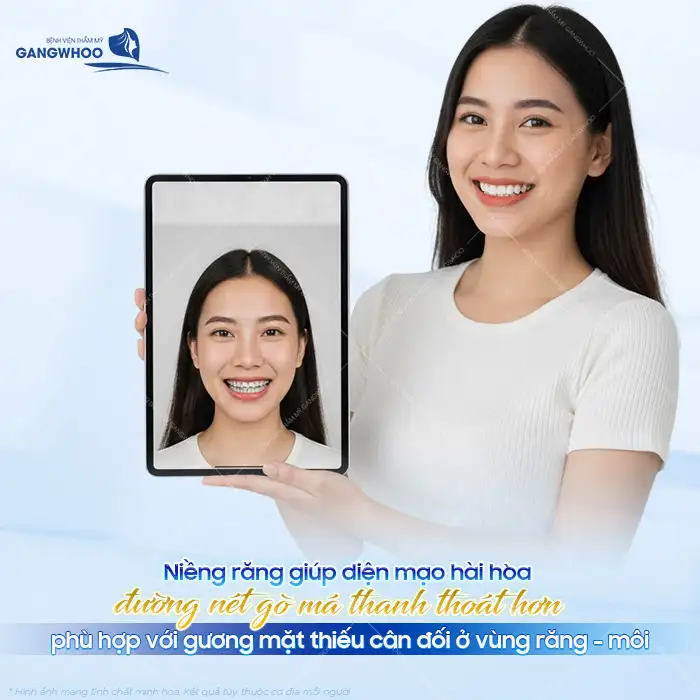 Niềng răng có hạ gò má không? Có tác động thay đổi gò má không?