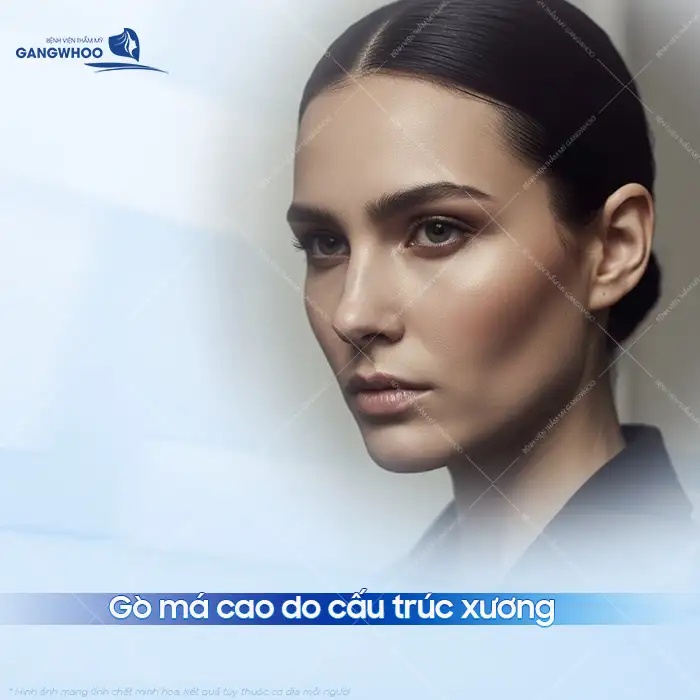Niềng răng có hạ gò má không? Có tác động thay đổi gò má không?