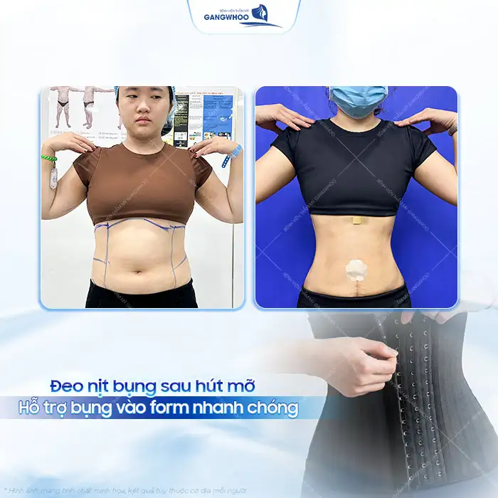 Vì sao phải đeo nịt bụng sau hút mỡ? Nên đeo nịt bụng bao lâu