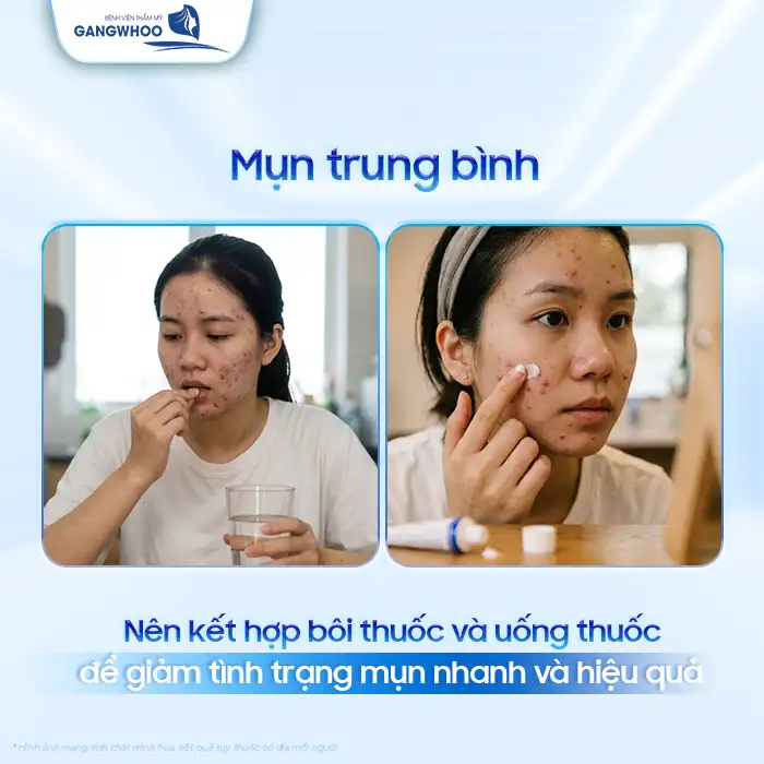 Phác đồ điều trị mụn trứng cá theo Bộ Y Tế bao gồm các bước nào