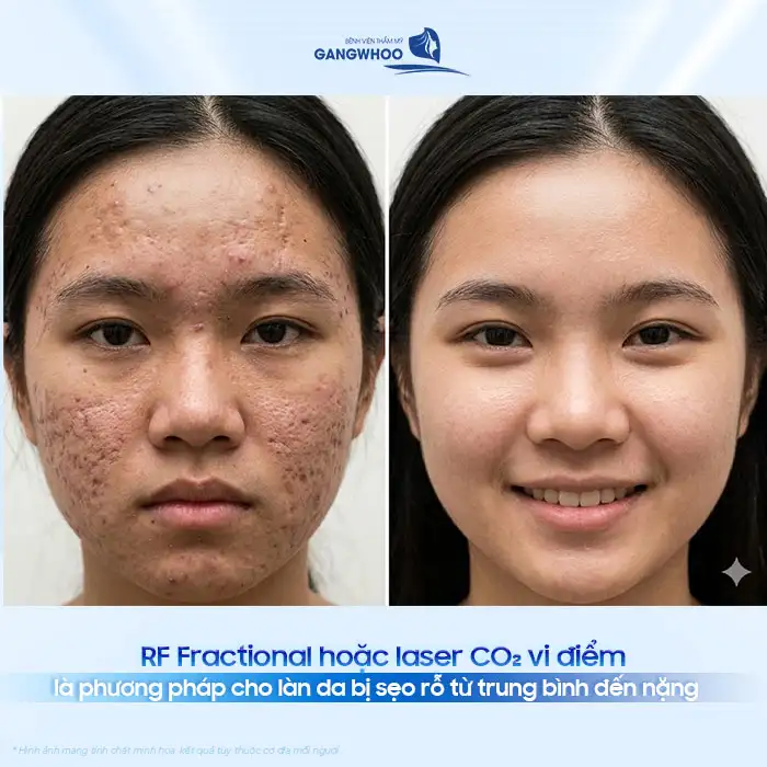 Phác đồ điều trị mụn trứng cá theo Bộ Y Tế bao gồm các bước nào