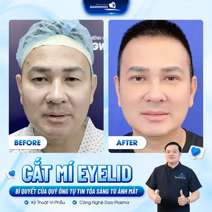 Phẫu thuật cắt mí mắt có nguy hiểm không? Những yếu tố cần lưu ý