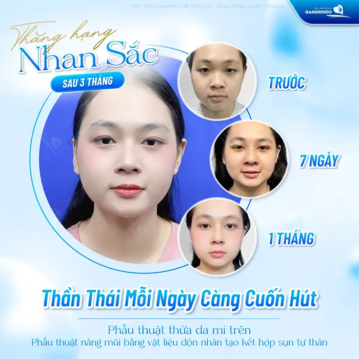 Phẫu thuật cắt mí mắt có nguy hiểm không? Những yếu tố cần lưu ý