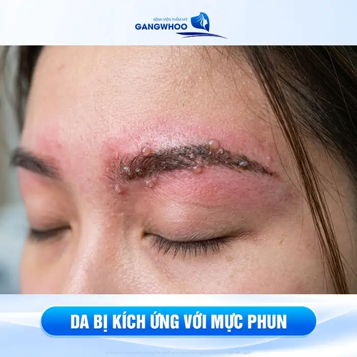 Phun lông mày bị nổi mụn nước nguyên nhân do đâu? Cách xử lý ra sao?