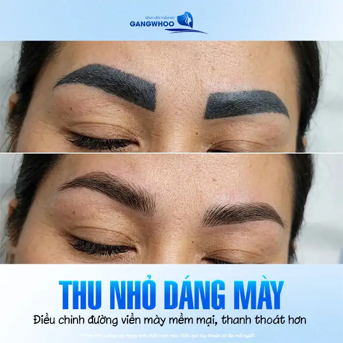 Phun lông mày bị to quá phải làm sao? Nguyên nhân và cách khắc phục
