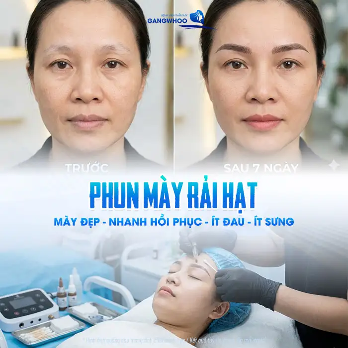 Phun mày rải hạt là gì? Có những ưu, nhược điểm ra sao?