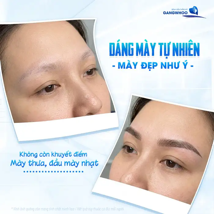 Phun mày rải hạt là gì? Có những ưu, nhược điểm ra sao?