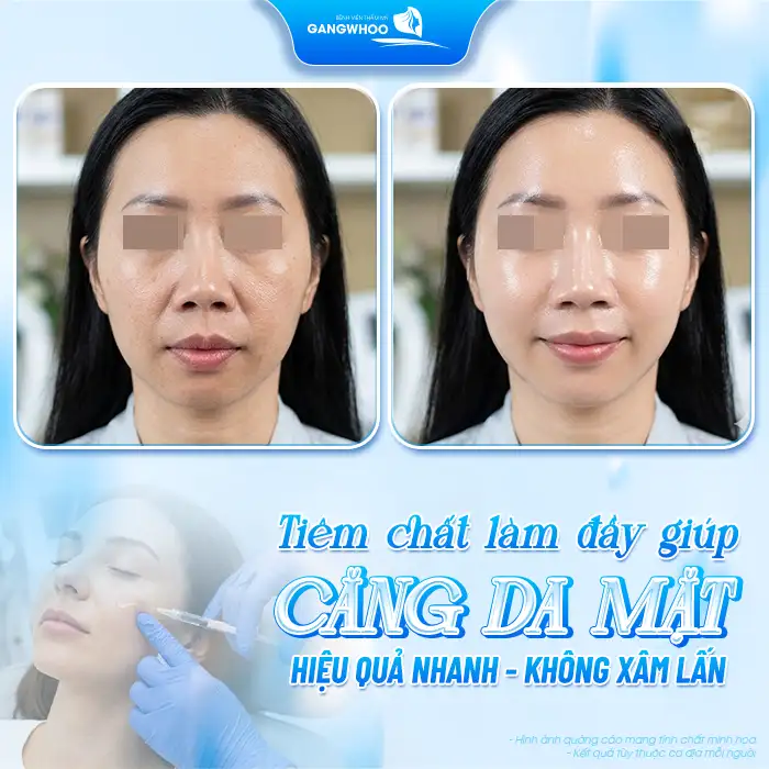 Phương pháp căng da mặt nào ? Tham khảo các phương pháp hiệu quả