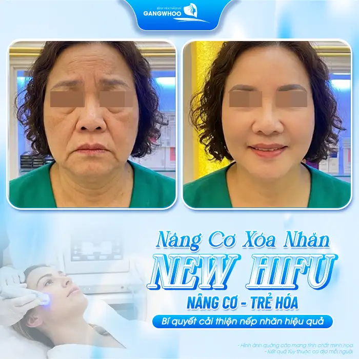 Phương pháp căng da mặt nào ? Tham khảo các phương pháp hiệu quả