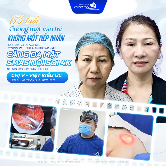 Phương pháp căng da mặt nào ? Tham khảo các phương pháp hiệu quả