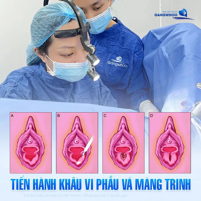 Quá trình vá màng trinh diễn ra như thế nào theo chuẩn y khoa
