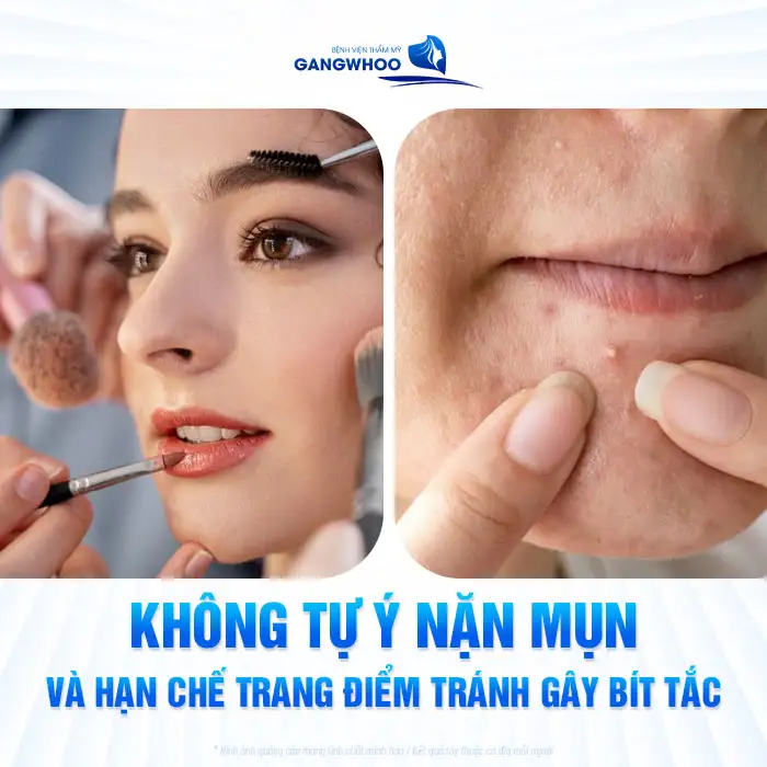 Tìm hiểu quy trỉnh điều trị mụn từng bước theo chuẩn y khoa