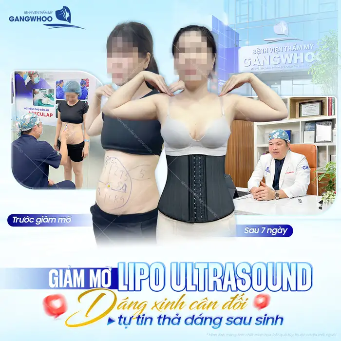 Quy trình hút mỡ bụng chuẩn y khoa, an toàn bao gồm mấy bước?