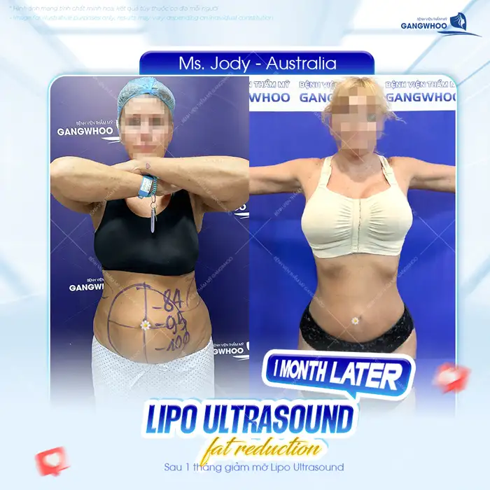 Quy trình hút mỡ bụng chuẩn y khoa, an toàn bao gồm mấy bước?