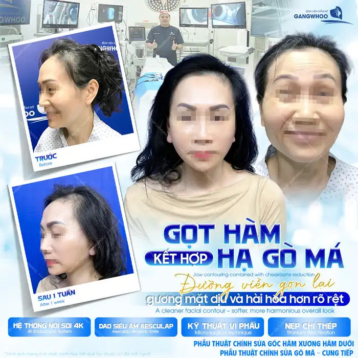 Tác hại của hạ gò má là gì? Yếu tố quyết định đến độ an toàn