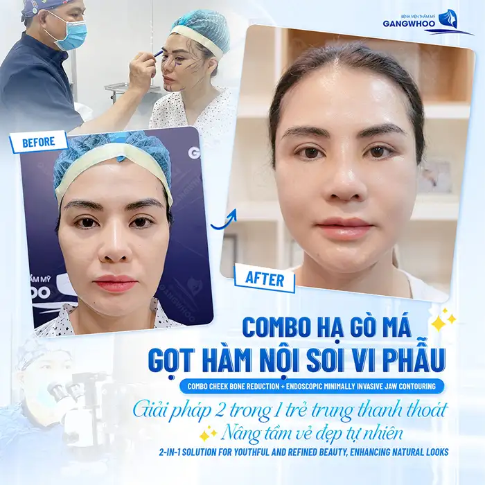 Tác hại của hạ gò má là gì? Yếu tố quyết định đến độ an toàn