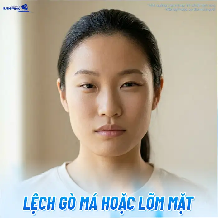 Tác hại của hạ gò má là gì? Yếu tố quyết định đến độ an toàn