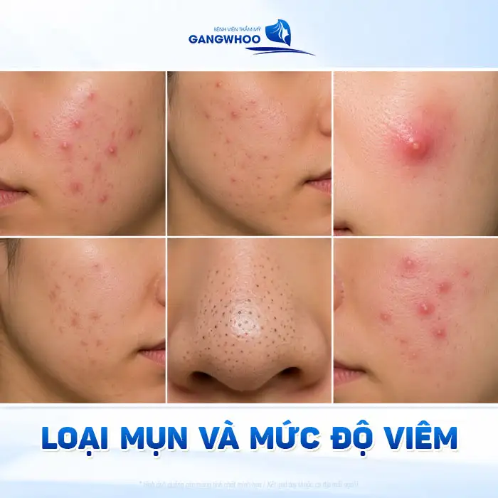 Thời gian điều trị mụn là bao lâu? Bác sĩ giải thích theo từng mức độ