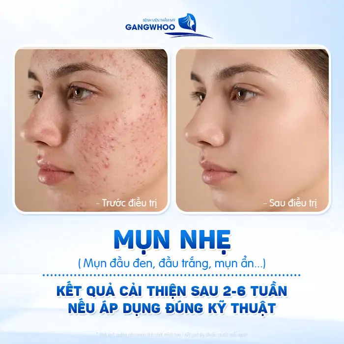 Thời gian điều trị mụn là bao lâu? Bác sĩ giải thích theo từng mức độ