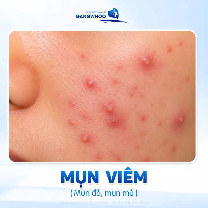 Thời gian điều trị mụn là bao lâu? Bác sĩ giải thích theo từng mức độ
