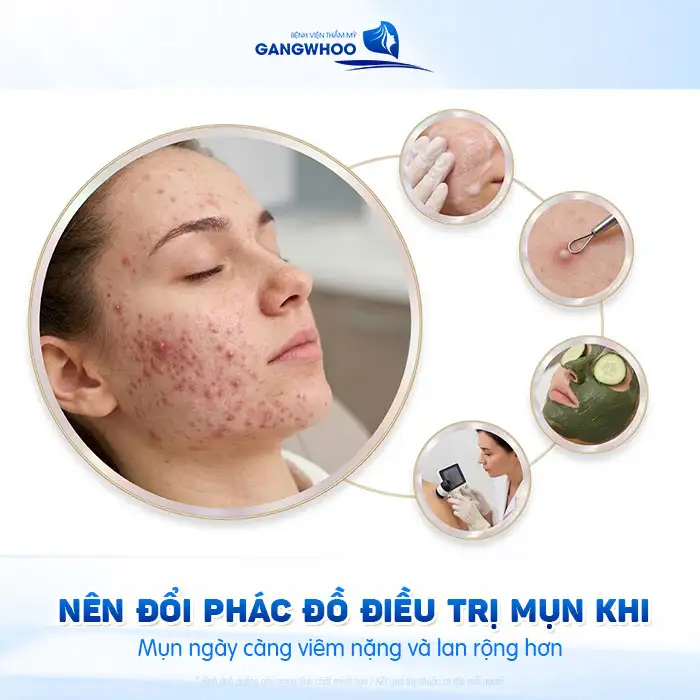 Thời gian điều trị mụn là bao lâu? Bác sĩ giải thích theo từng mức độ