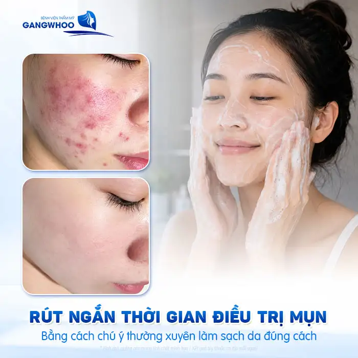 Thời gian điều trị mụn là bao lâu? Bác sĩ giải thích theo từng mức độ