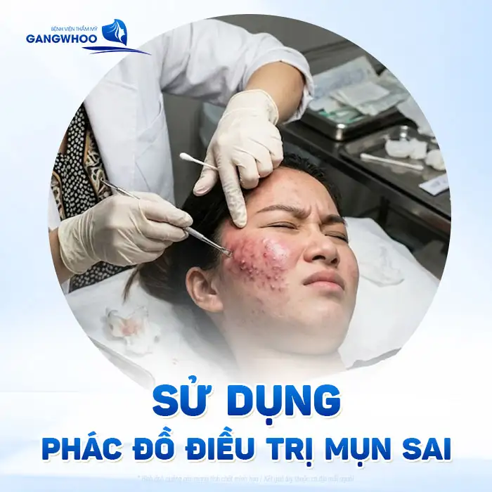 Thời gian điều trị mụn là bao lâu? Bác sĩ giải thích theo từng mức độ