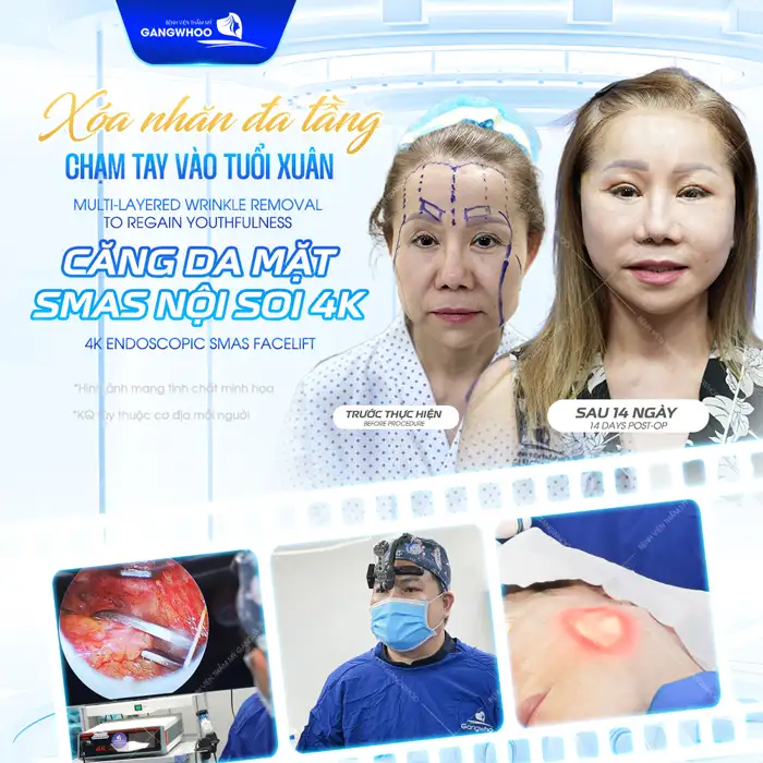 Phương pháp tiêm botox căng da mặt là gì? Ưu, nhược điểm khi tiêm botox