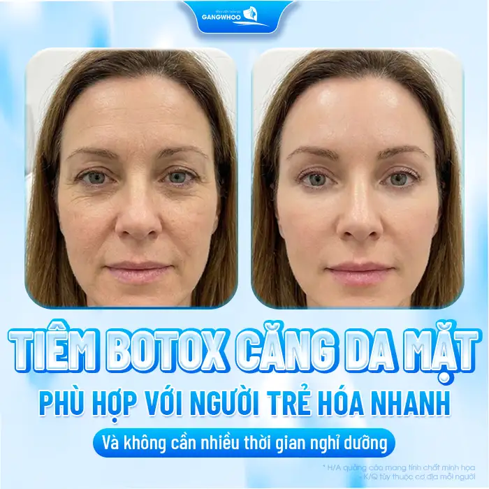 Phương pháp tiêm botox căng da mặt là gì? Ưu, nhược điểm khi tiêm botox