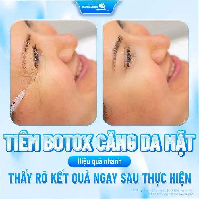 Phương pháp tiêm botox căng da mặt là gì? Ưu, nhược điểm khi tiêm botox