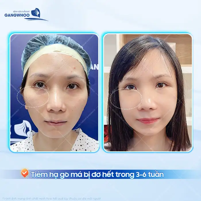Tiêm hạ gò má bị đơ có nguy hiểm không? Nguyên nhân và cách khắc phục