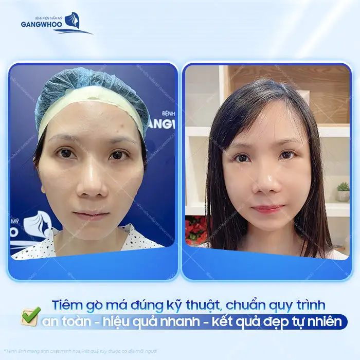Tiêm hạ gò má có nguy hiểm không? Rủi ro và cách phòng tránh