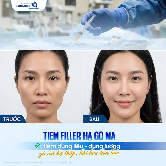 Tiêm hạ gò má có nguy hiểm không? Rủi ro và cách phòng tránh